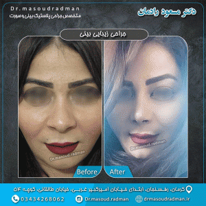 جراحی بینی گوشتی در کرمان - دکتر مسعود رادمان