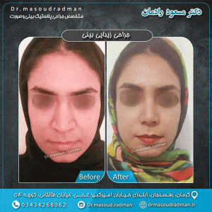 جراحی بینی گوشتی در کرمان - دکتر رادمان