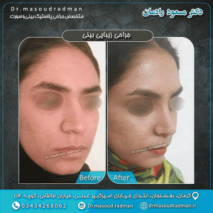 جراحی بینی گوشتی در رفسنجان - دکتر مسعود رادمان