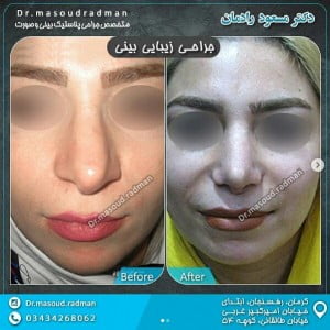 جراحی بینی گوشتی در رفسنجان - دکتر رادمان