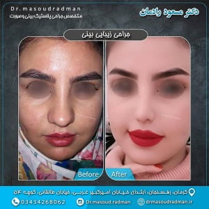 جراحی بینی گوشتی - دکتر رادمان