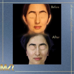 otoplasty-7