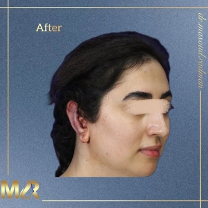 otoplasty-9