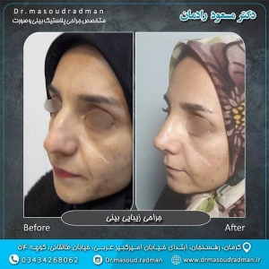 جراحی-بینی-در-کرمان-100