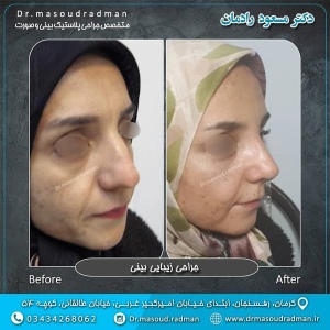 جراحی-بینی-در-کرمان-101