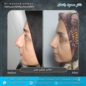 جراحی-بینی-در-کرمان-102