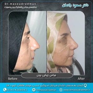 جراحی-بینی-در-کرمان-103