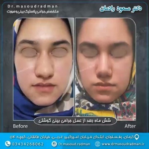 جراحی-بینی-در-کرمان-104