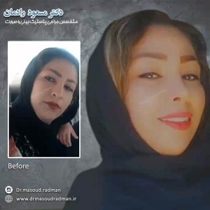 جراحی-بینی-در-کرمان-105