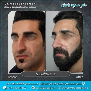 جراحی-بینی-در-کرمان-106