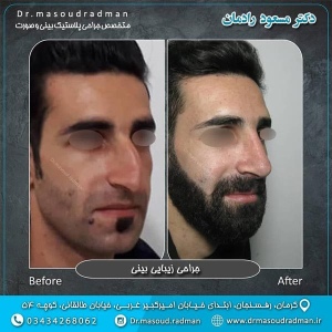 جراحی-بینی-در-کرمان-107