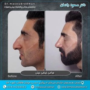جراحی-بینی-در-کرمان-108