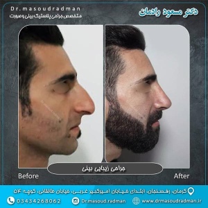 جراحی-بینی-در-کرمان-109