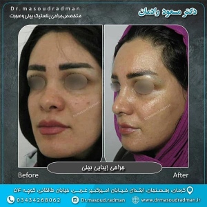 جراحی-بینی-در-کرمان-110