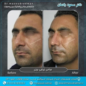 جراحی-بینی-در-کرمان-115