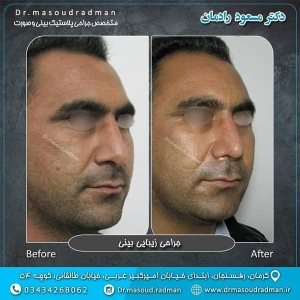 جراحی-بینی-در-کرمان-116