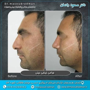 جراحی-بینی-در-کرمان-117