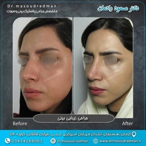 جراحی-بینی-در-کرمان-120