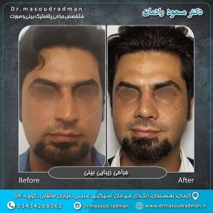 جراحی-بینی-در-کرمان-123