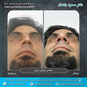 جراحی-بینی-در-کرمان-124