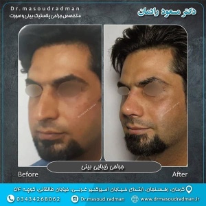جراحی-بینی-در-کرمان-125
