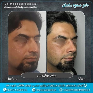 جراحی-بینی-در-کرمان-126