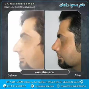 جراحی-بینی-در-کرمان-127