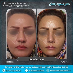 جراحی-بینی-در-کرمان-128