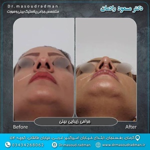 جراحی-بینی-در-کرمان-129