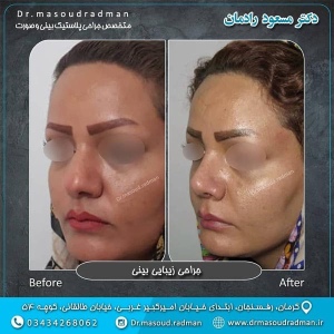 جراحی-بینی-در-کرمان-130