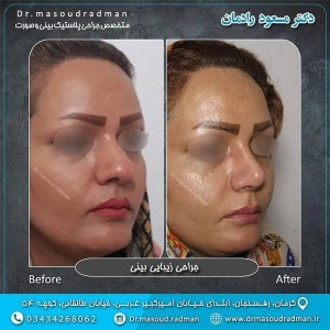 جراحی-بینی-در-کرمان-131