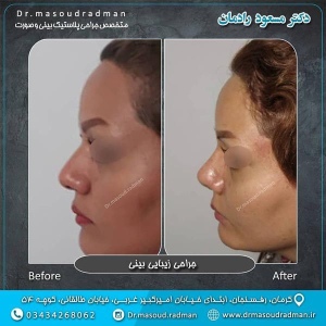 جراحی-بینی-در-کرمان-132