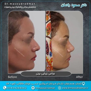 جراحی-بینی-در-کرمان-133