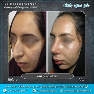 جراحی-بینی-در-کرمان-137