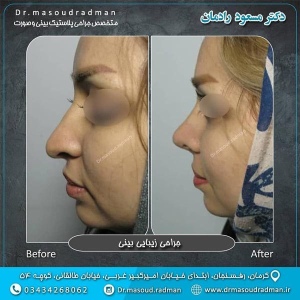 جراحی-بینی-در-کرمان-140