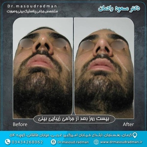 جراحی-بینی-در-کرمان-143