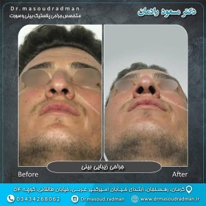 جراحی-بینی-در-کرمان-168