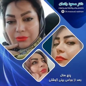 جراحی-بینی-در-کرمان-178