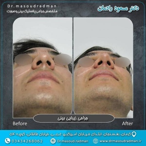 جراحی-بینی-در-کرمان-180