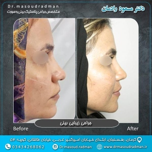 جراحی-بینی-در-کرمان-209