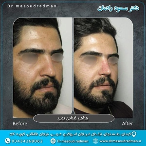 جراحی-بینی-در-کرمان-212