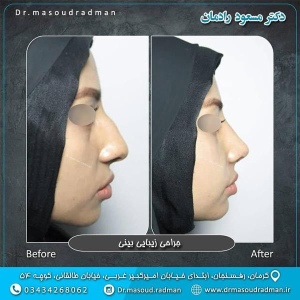 جراحی-بینی-در-کرمان-213