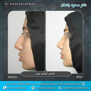 جراحی-بینی-در-کرمان-214