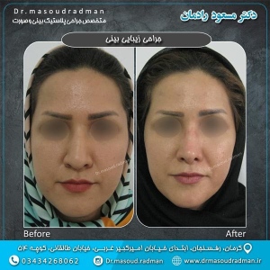 جراحی-بینی-در-کرمان-22