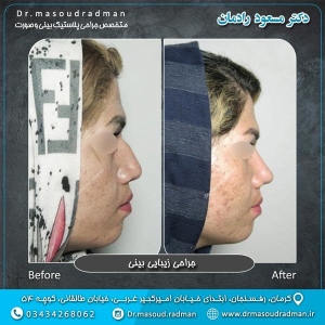 جراحی-بینی-در-کرمان-227