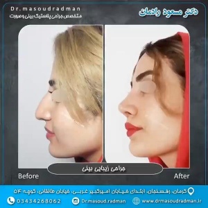 جراحی-بینی-در-کرمان-239