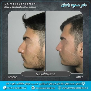 جراحی-بینی-در-کرمان-240