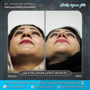 جراحی-بینی-در-کرمان-248