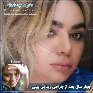 جراحی-بینی-در-کرمان-255