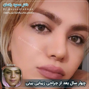 جراحی-بینی-در-کرمان-256